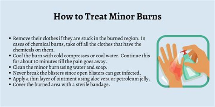How do you treat acne cream from burns?