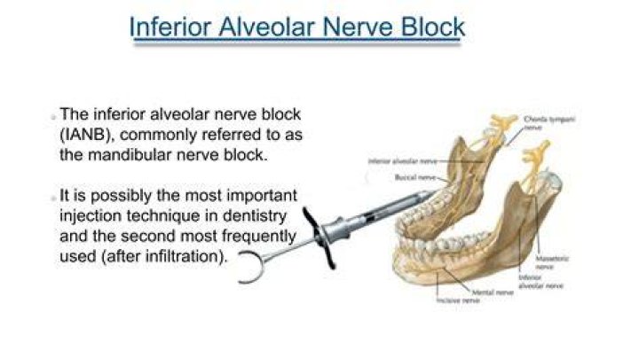 How long does an inferior alveolar nerve block last?