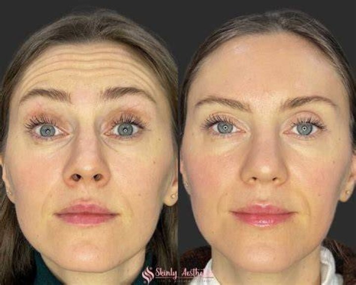 How much does forehead contouring cost?