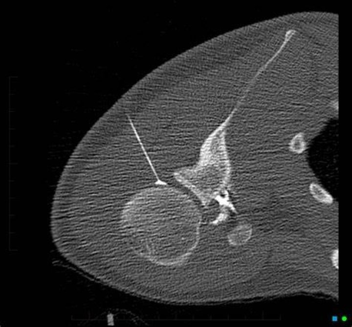 Is a CT arthrogram painful?