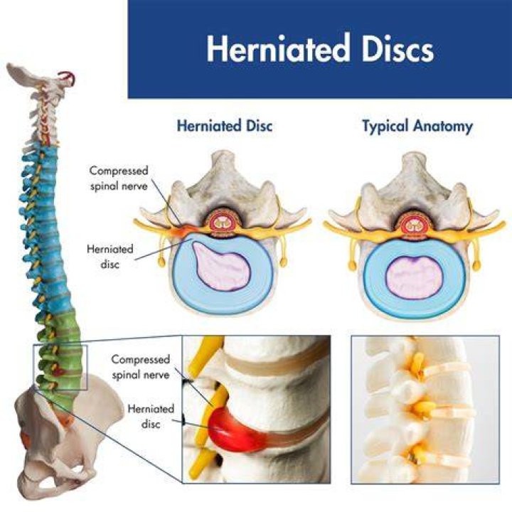 What aggravates a herniated lumbar disc?