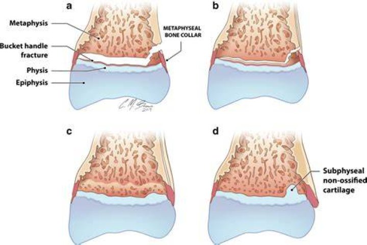 What are classic metaphyseal lesions?