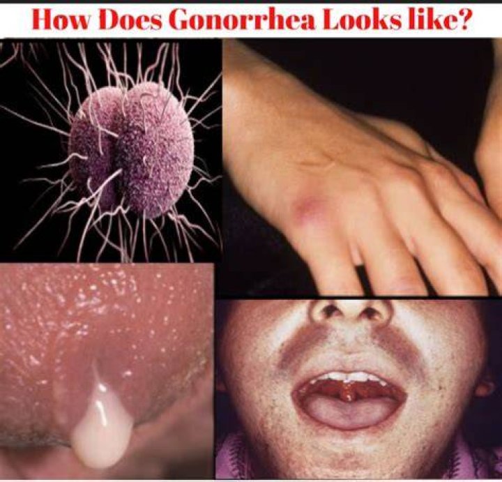 What bacteria looks like gonorrhea?