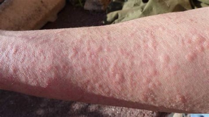 What causes severe itching on top of arms?