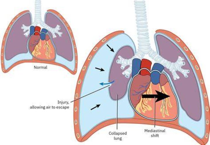 What does a mediastinal shift do?