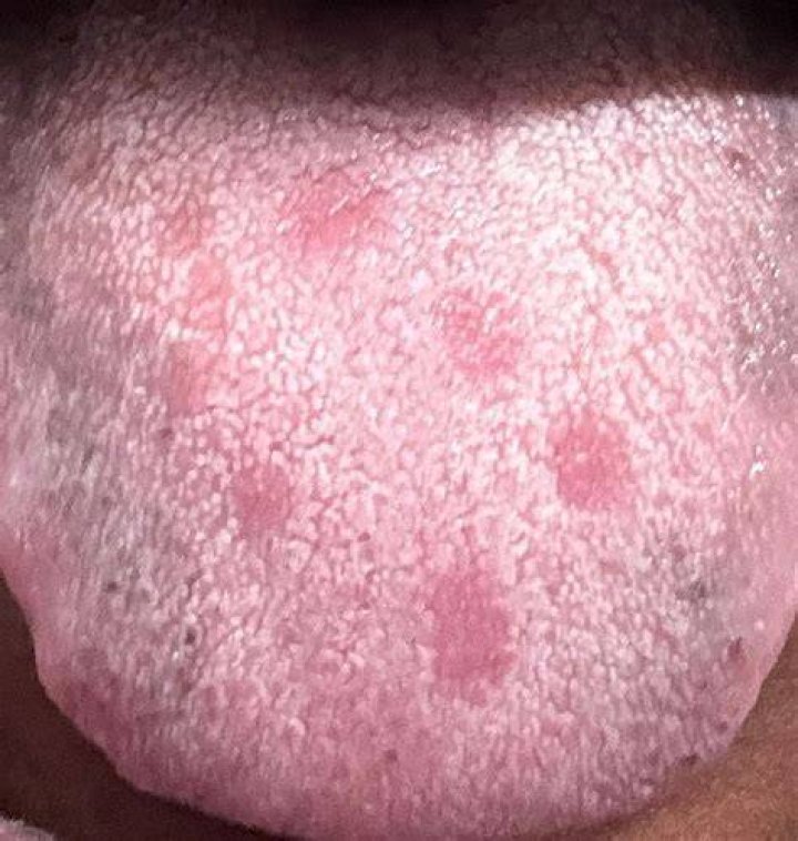 What does it mean if you have spots on the back of your tongue?