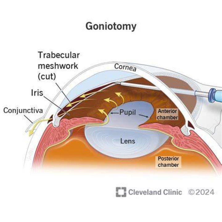 What is a Goniotomy procedure?