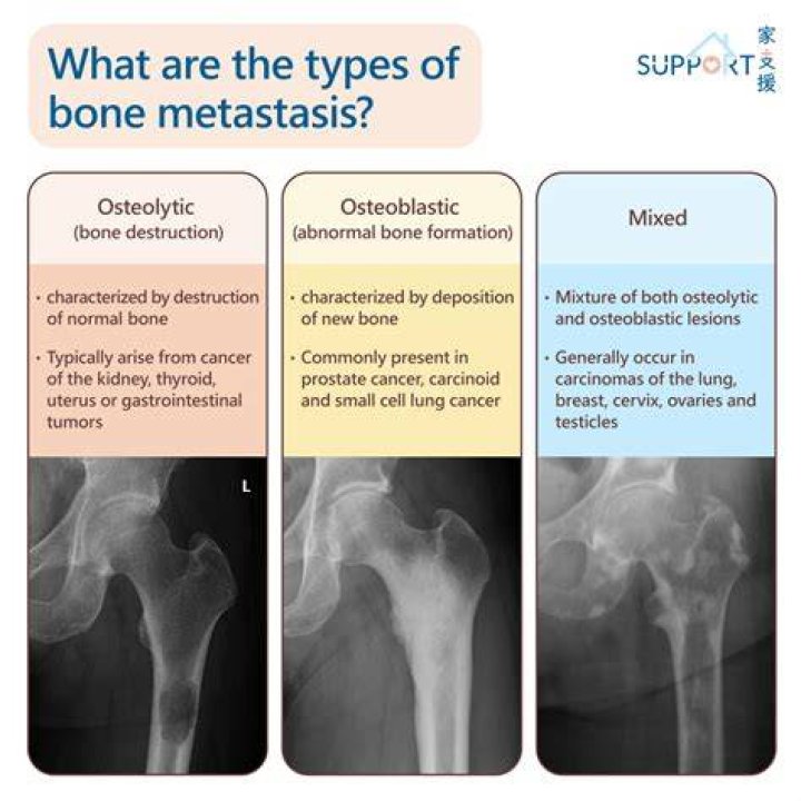 What is osteoblastic cancer?