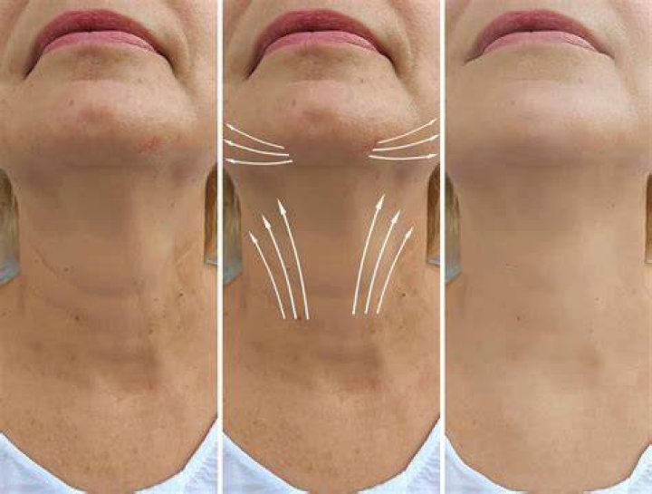 What is the best treatment for saggy neck?