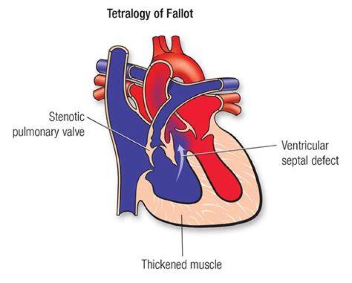 What is the first signs of tetralogy of Fallot?