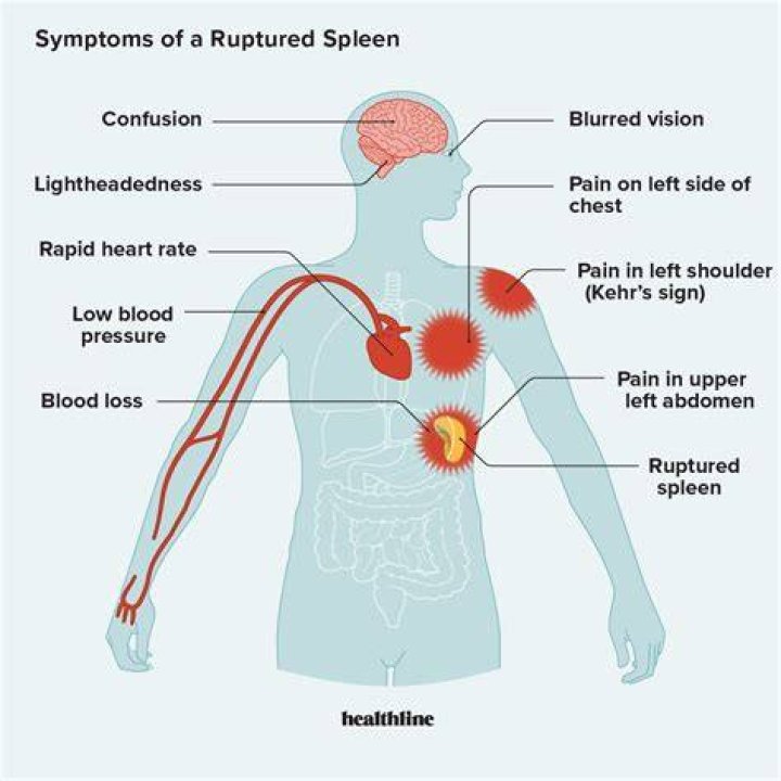Where does a ruptured spleen hurt?
